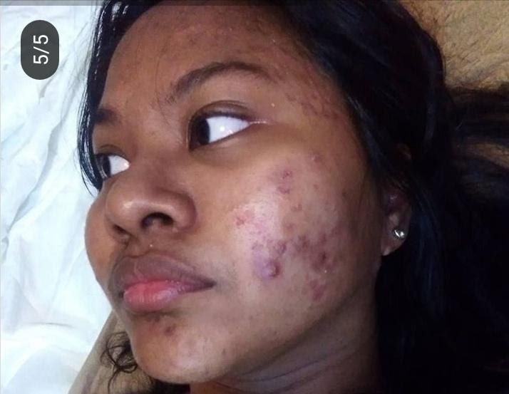 severe acne