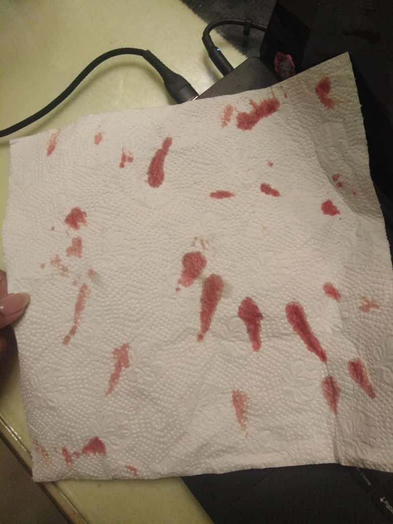severe acne